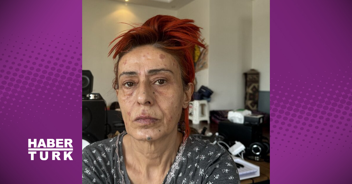 Yıldız Tilbe: Kimyasal yanık oldum